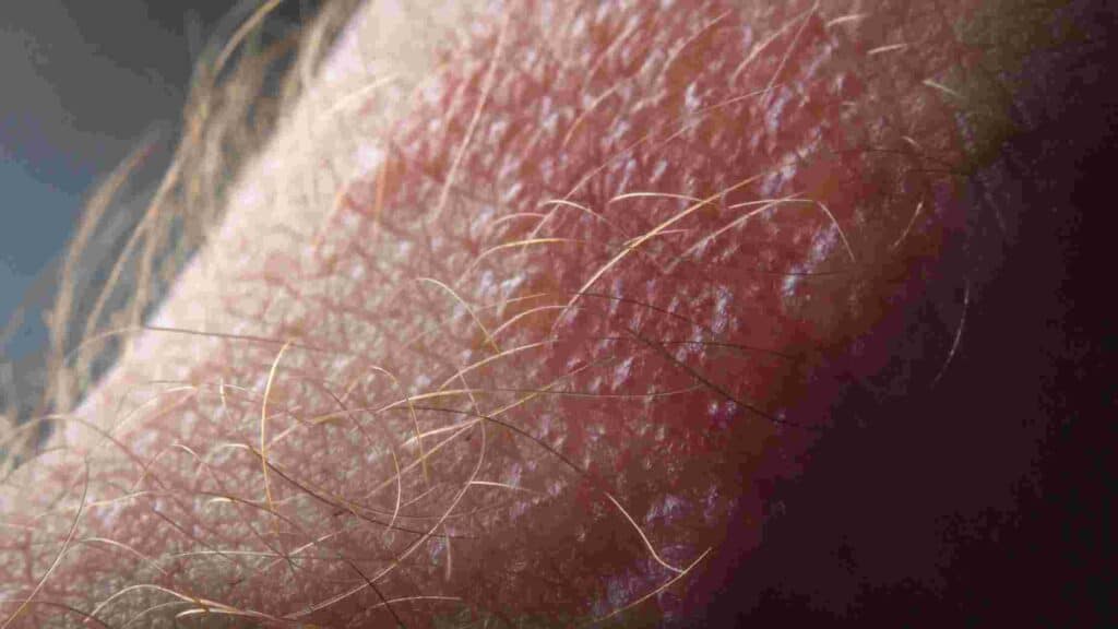poison ivy rash